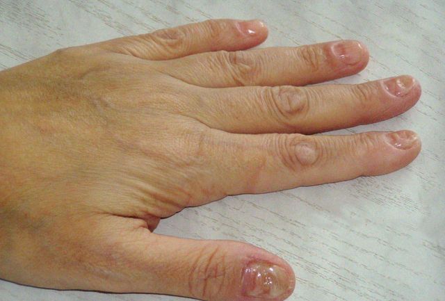 Деформация ногтей, чем лечить