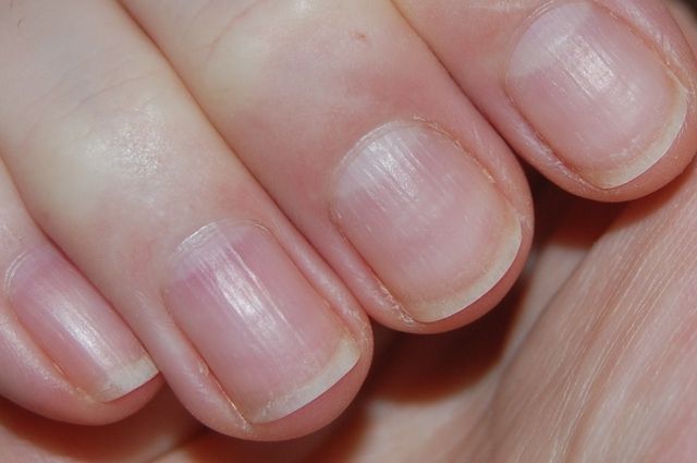 Как бороться с ребристыми и волнистыми ногтями Как бороться с ребристыми и волнистыми ногтями