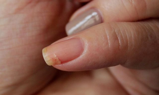 Ломкость ногтей – причины появления и методы лечения